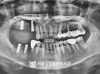 발치 후 즉시식립 4개 - 오스템 치료 후