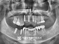 발치 즉시 식립 뼈이식임플란트 5개 - 오스템 치료 후