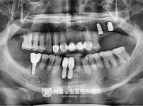 잘못 식립된 임플란트 제거 후 즉시 식립 2개 - 네오 최종 치료 전