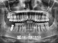 발치 후 즉시 식립 1개 -오스템 치료 후