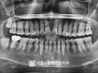 발치 후 즉시 식립 1개 -오스템 치료 전
