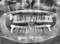 상악동거상술 후 임플란트1개 - 오스템 치료 후