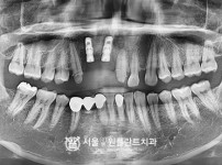 잘못 식립된 임플란트 제거 후 임플란트 2개 - 오스템 치료 후