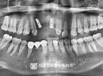 잘못 식립된 임플란트 제거 후 임플란트 2개 - 오스템 치료 전