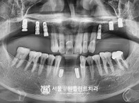 발치 즉시 식립 뼈이식 임플란트 8개 - 오스템 치료 후