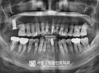상악동거상술 후 임플란트 1개 - 오스템 치료 후