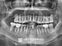 상악동거상술 후 임플란트 1개 - 오스템 치료 전