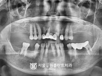 발치 후 즉시 식립 4개 - 오스템 치료 전