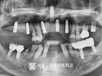 발치 후 즉시식립 뼈이식 임플란트 5개 - 네오 치료 후
