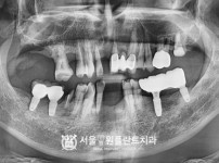 발치 후 즉시식립 뼈이식 임플란트 5개 - 네오 치료 전