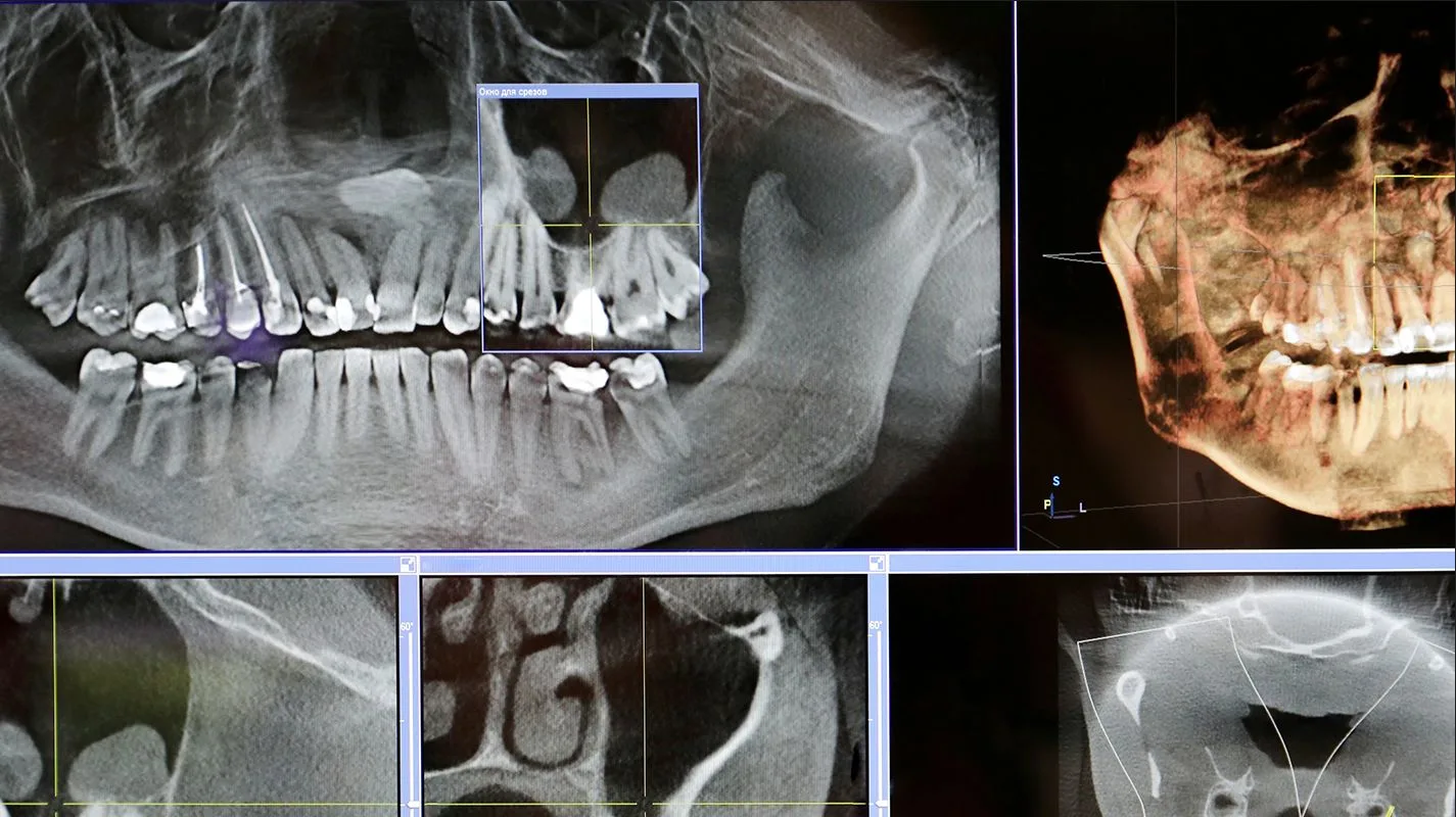 파노라마·3D-CT 영상으로 잇몸뼈와 신경 위치를 분석한 진단 자료 화면